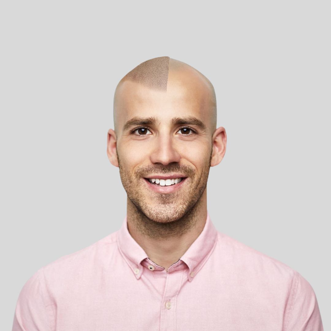 SMP for Male Pattern Baldness No BG.png