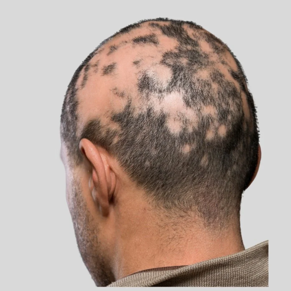 SMP for Alopecia.jpg
