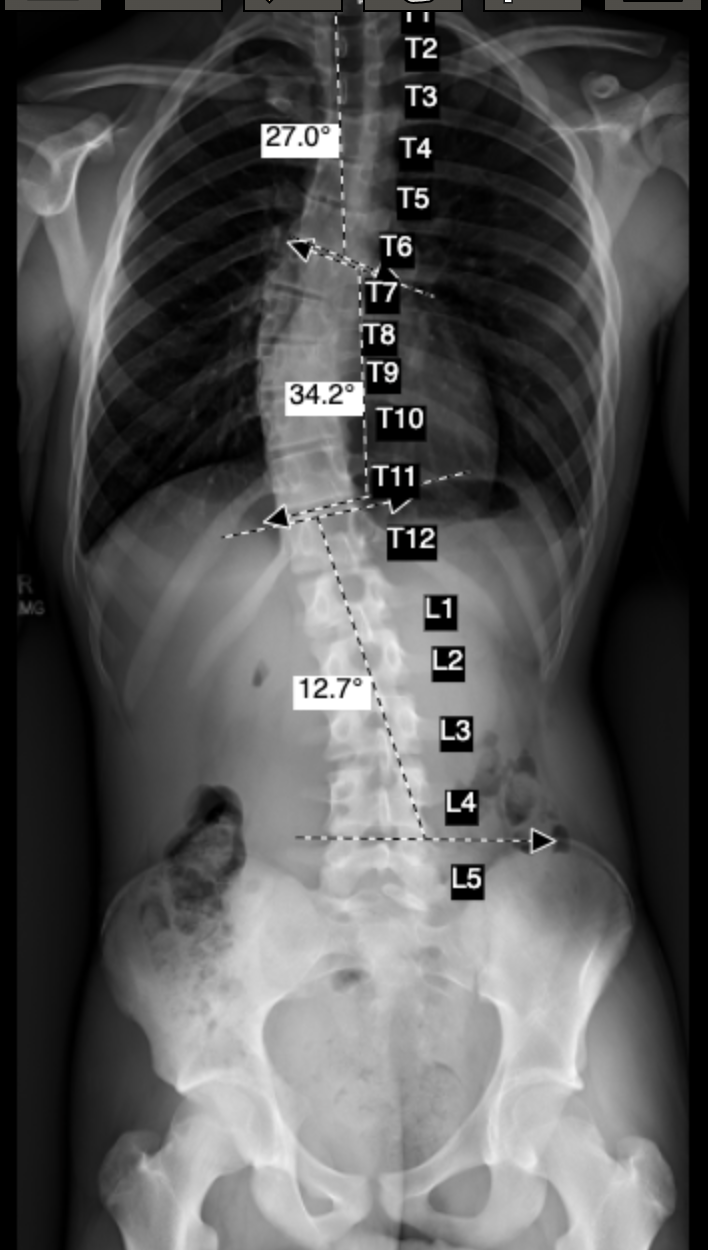 Blue Short X-Ray.png