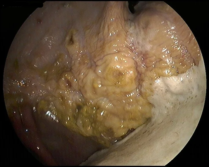 Starch & ulcers: What’s the deal?