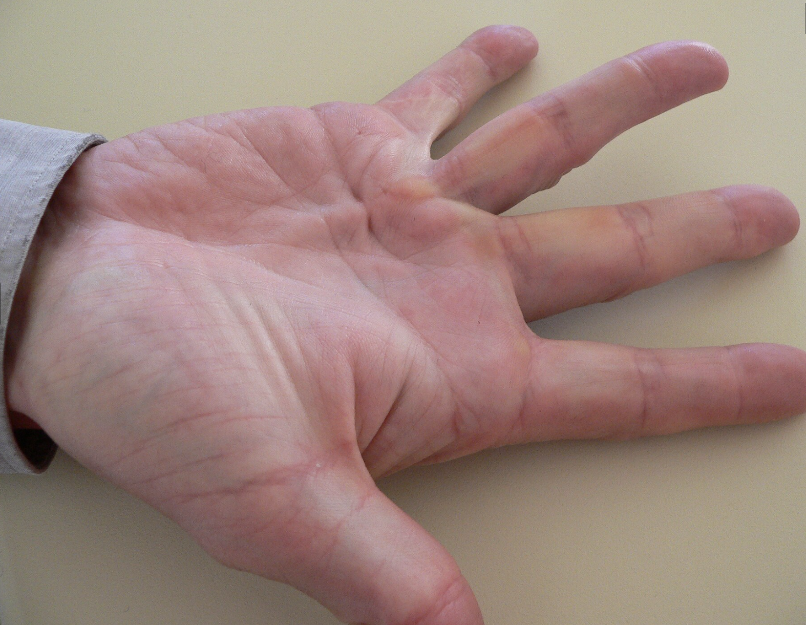 Dupuytren’s Contracture: When to Consider Treatment