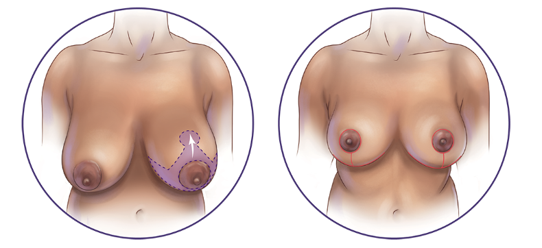 breast reduction