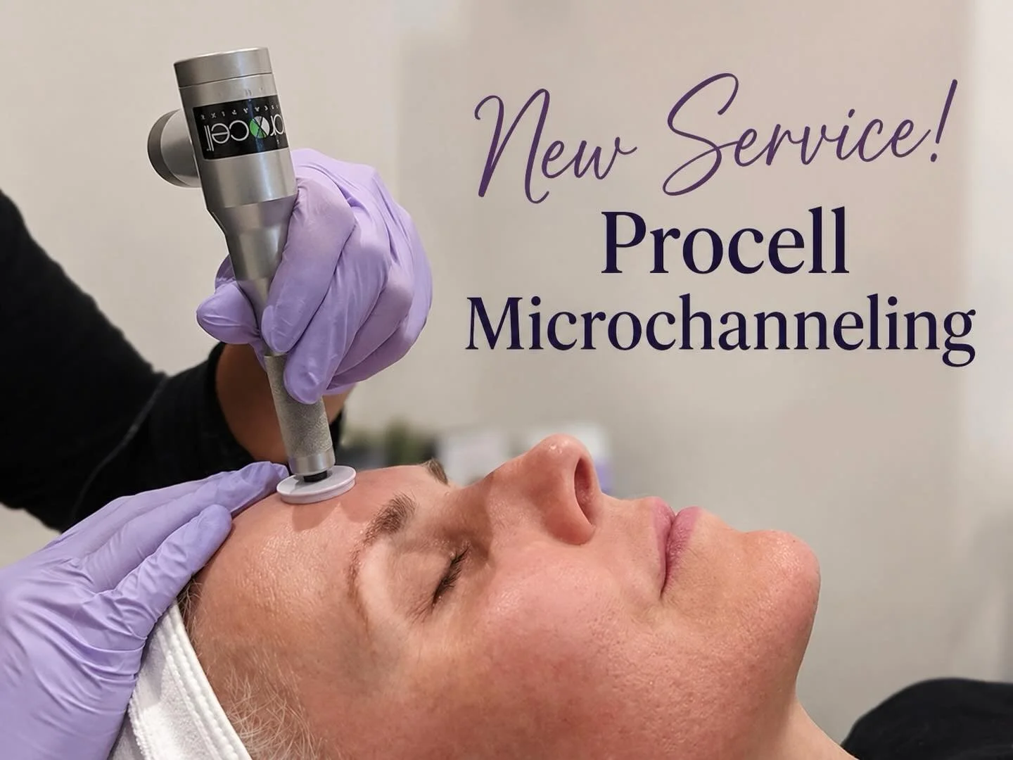 We are so excited to bring a new service to our clients! Procell Microchanneling! 

✨What is microchanneling? ✨Unlike traditional methods, microchanneling uses a precise stamping technique that creates evenly spaced channels without dragging or teari