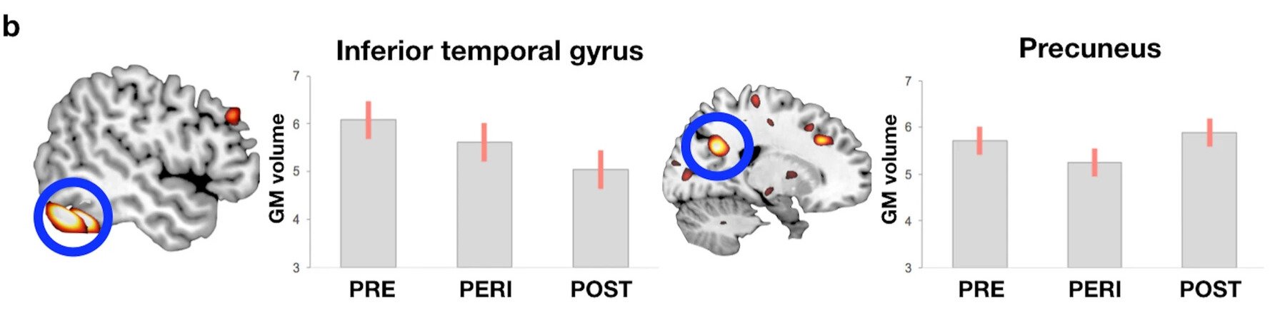 perimenopause memory brain changes