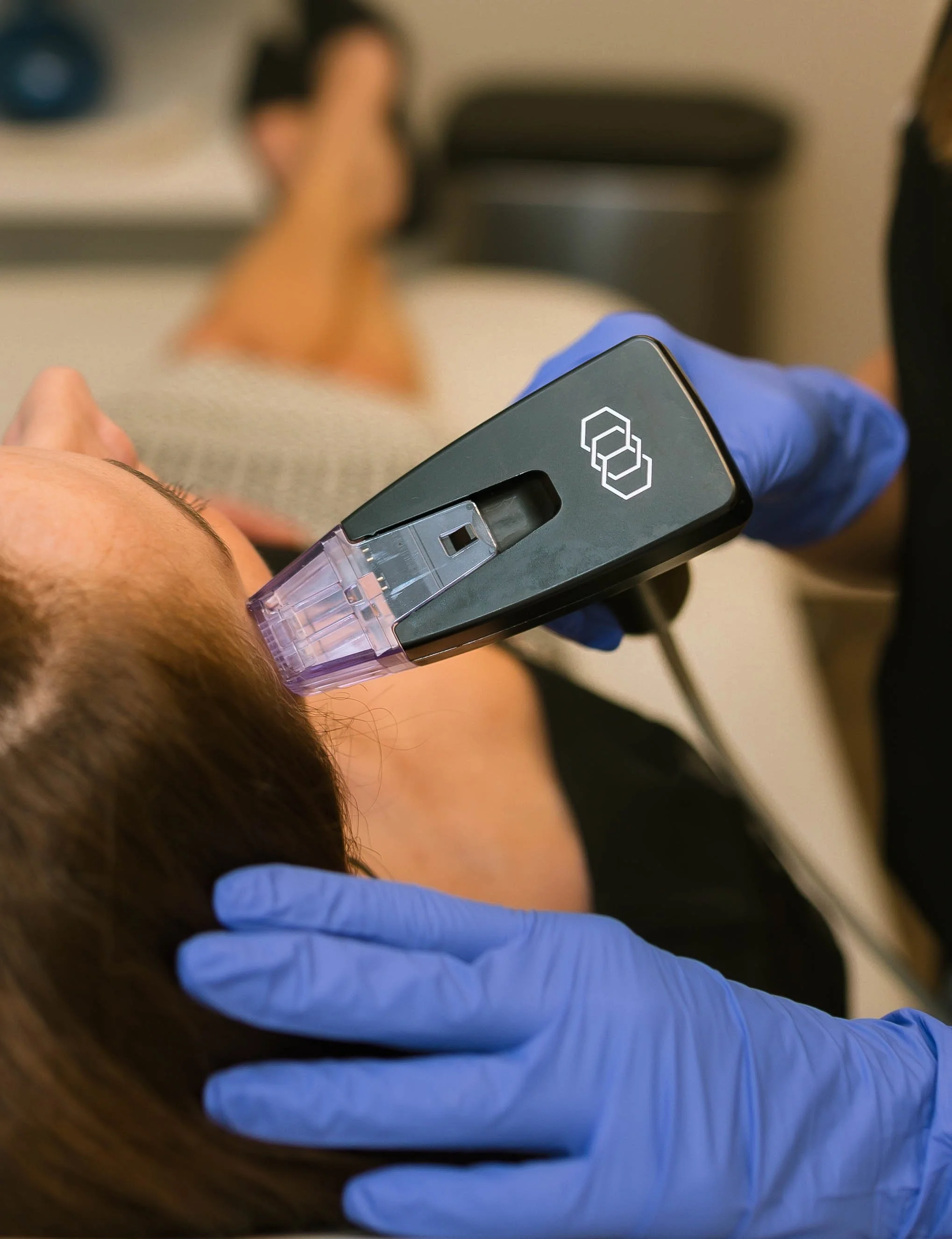 Morpheus8 Microneedling Treatment at omaha med spa
