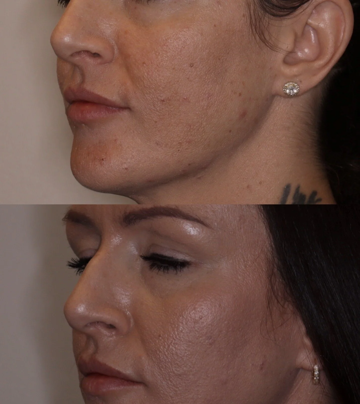 Before and after Voluma cheek filler and Kysse lip filler