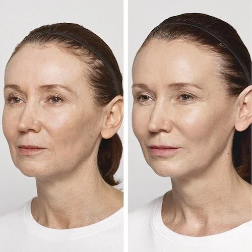 Comparison photo of a woman showing before and after skin treatment, with improved skin appearance in the after image.