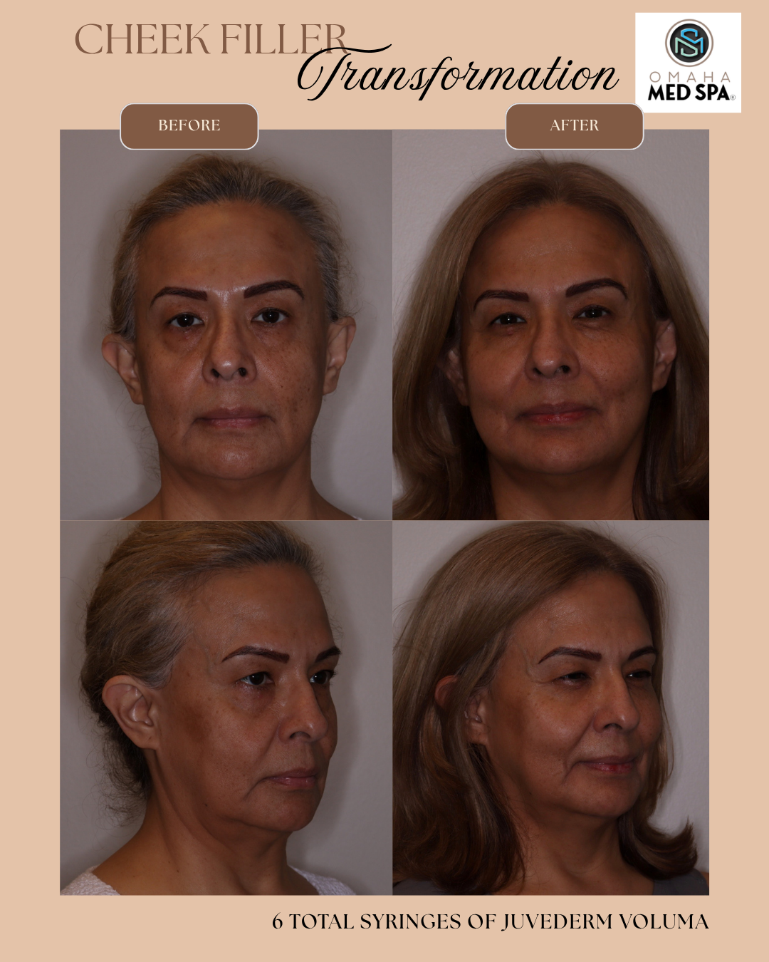 image of mature women before and after she received 6 syringes of Voluma cheek filler