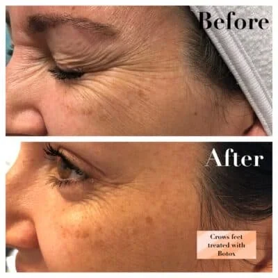 Comparison photo showing wrinkles around the eye before and after treatment with botox.