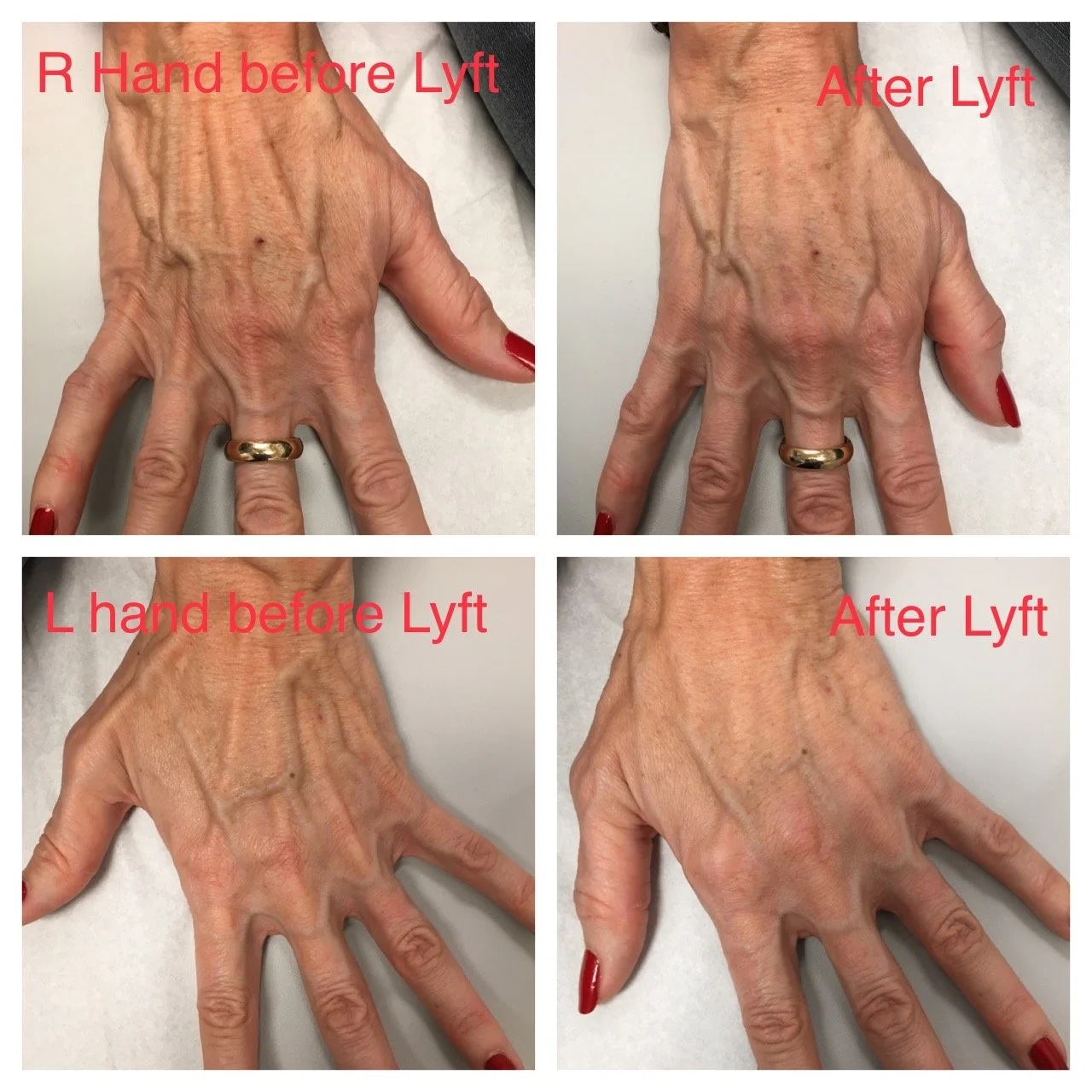Comparison images of the right and left hands before and after a cosmetic procedure called a lift. The 'before' images show more prominent veins, wrinkles, and signs of aging. The 'after' images reveal smoother skin, reduced visibility of veins and w