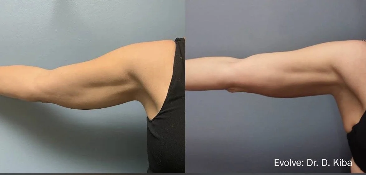 Evolve X before and after upper arm treatment