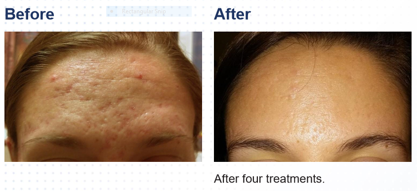 Side-by-side comparison of a person's forehead showing before and after acne treatment. The 'before' image displays inflamed, red, and pitted skin, while the 'after' image shows clear skin with reduced blemishes, after four treatments.