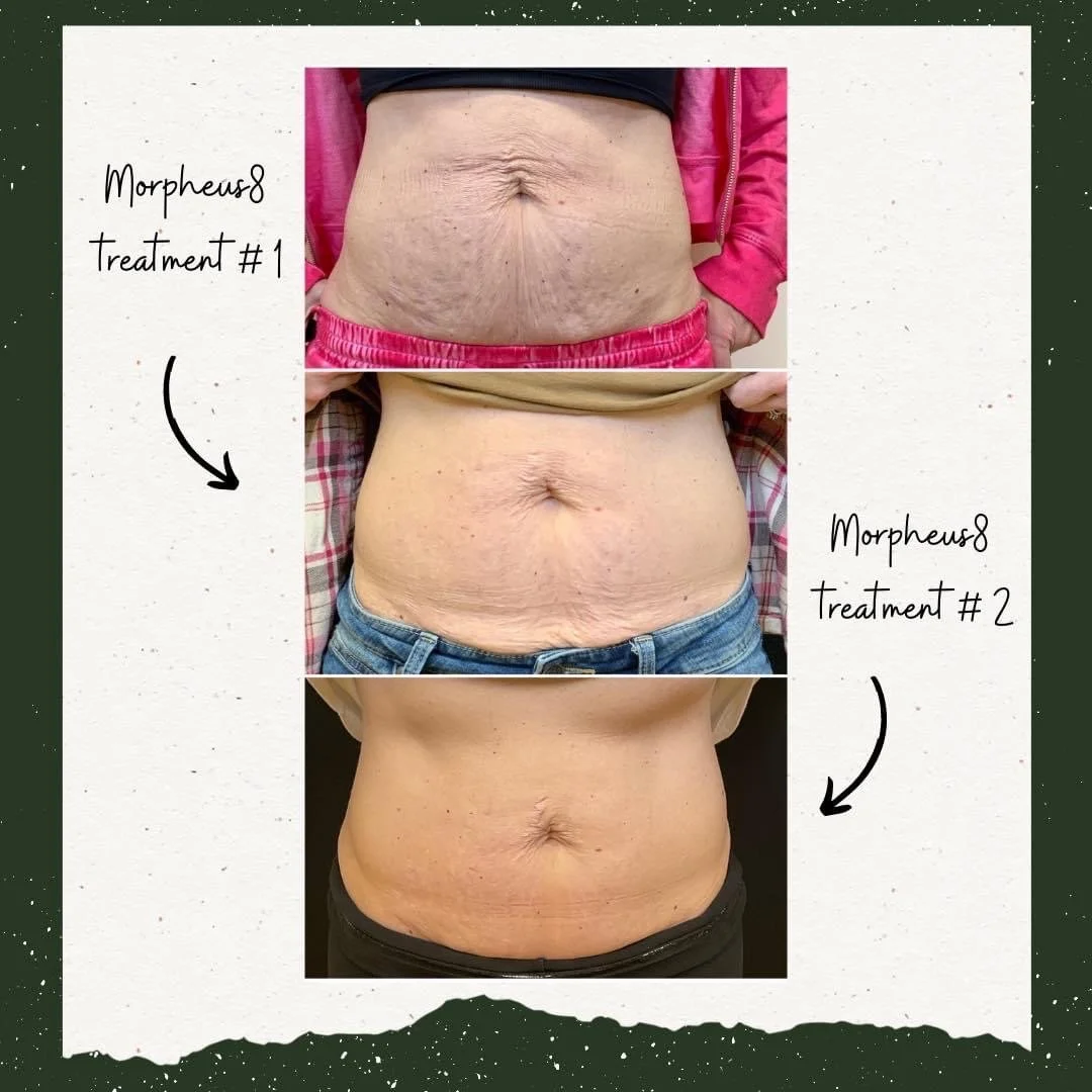 Progress photos showing the increase in skin tightness and reduction of wrinkles on a person's abdomen after two treatments with Morpheus8, a skin treatment device.