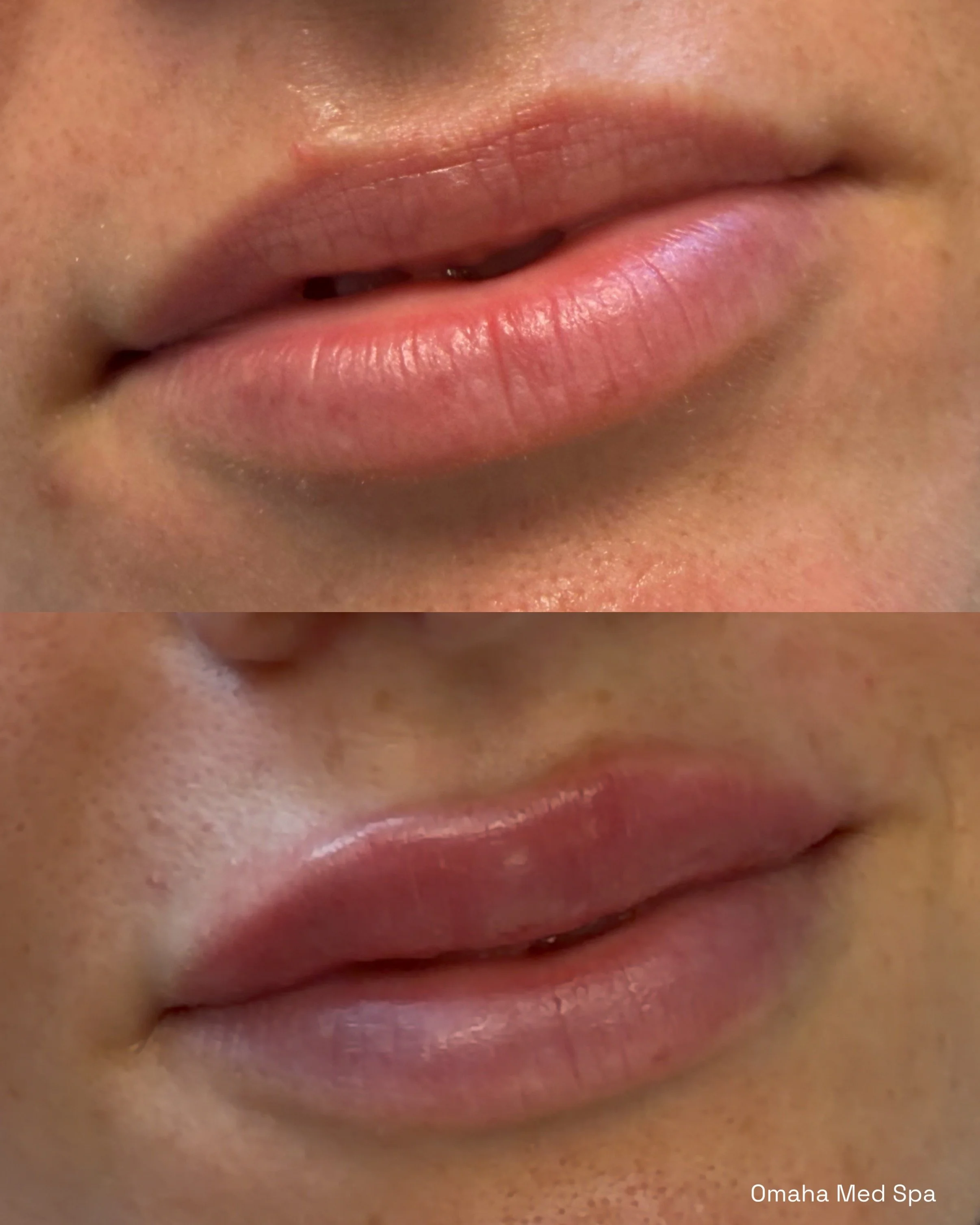 Before (above) and After (below) same day lip augmentation with Juvederm Ultra lip filler. 
