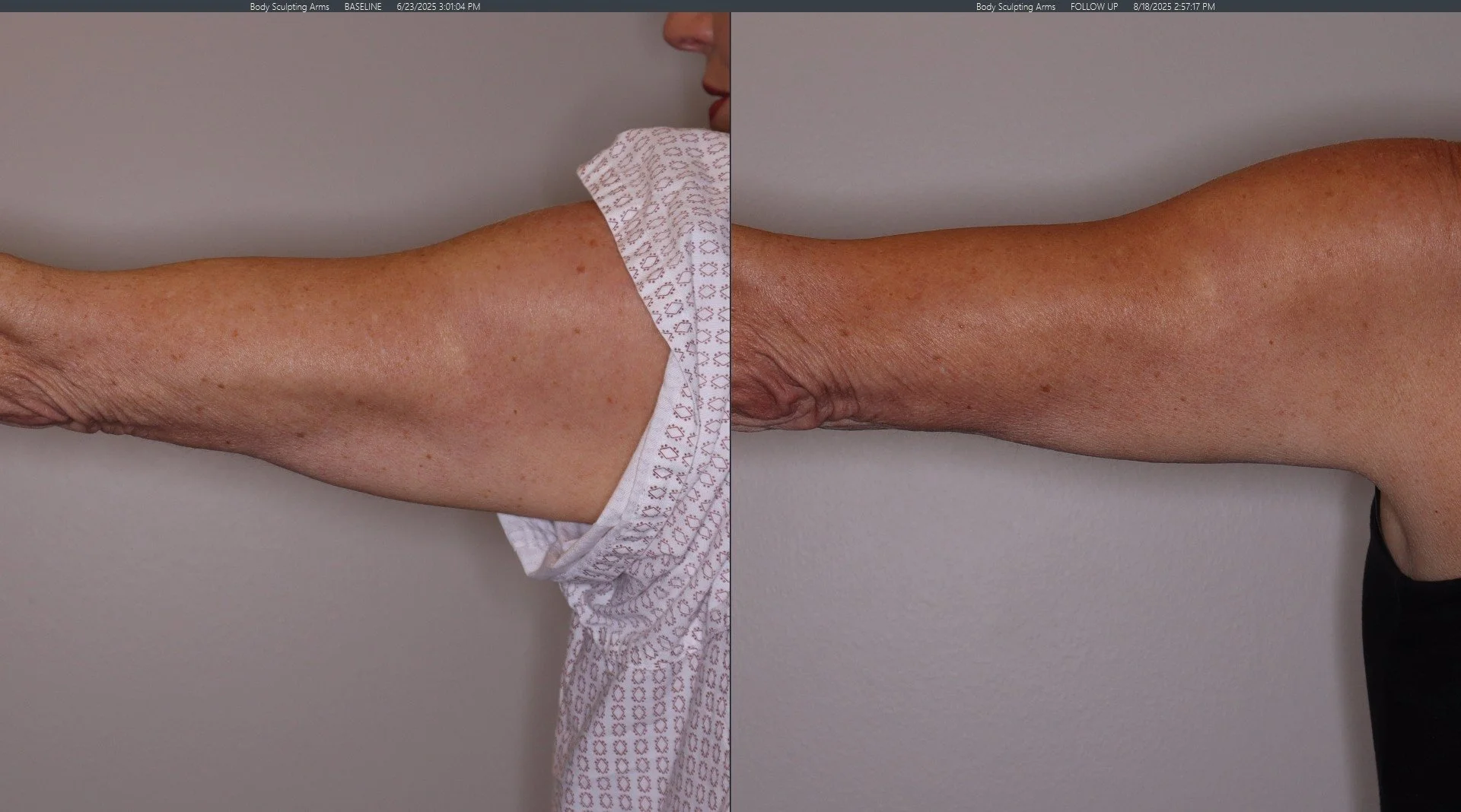 Before and After 12 sessions of EvolveX for arm skin tightening and fat reduction