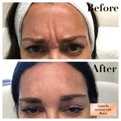 Side-by-side comparison of a woman's forehead and eyebrows before and after Botox treatment, showing reduced wrinkles after the procedure.