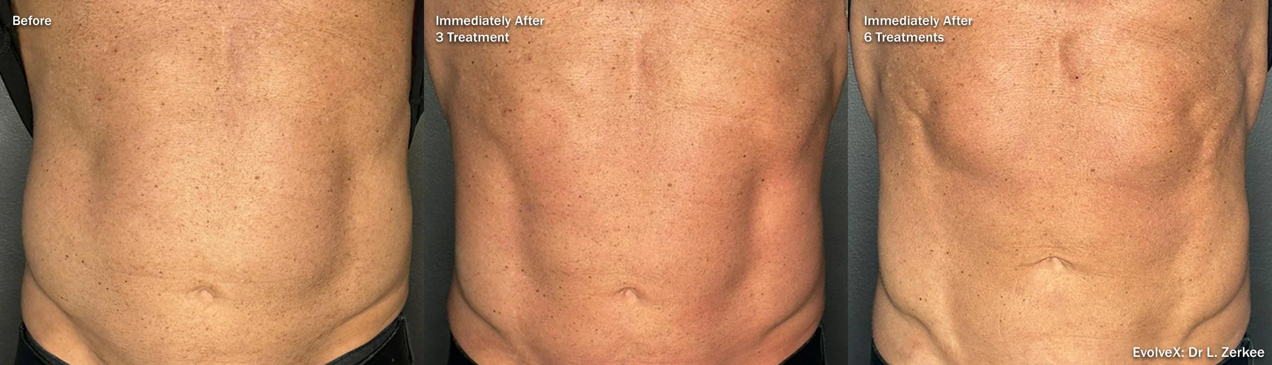 Comparison of a person's abdomen before, after 3 treatments, and after 6 treatments, showing reduction in skin laxity and improved skin texture.