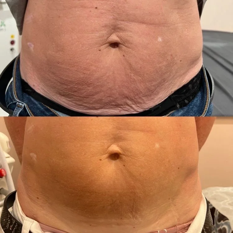 Comparison of a person's abdominal area before and after weight loss or skin treatment, showing reduced skin sagging and improved skin appearance.