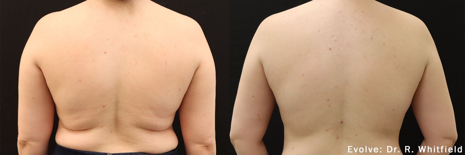 Comparison of the back view of a person's torso before and after a medical treatment, showing improvements in skin firmness and reduction of fat.