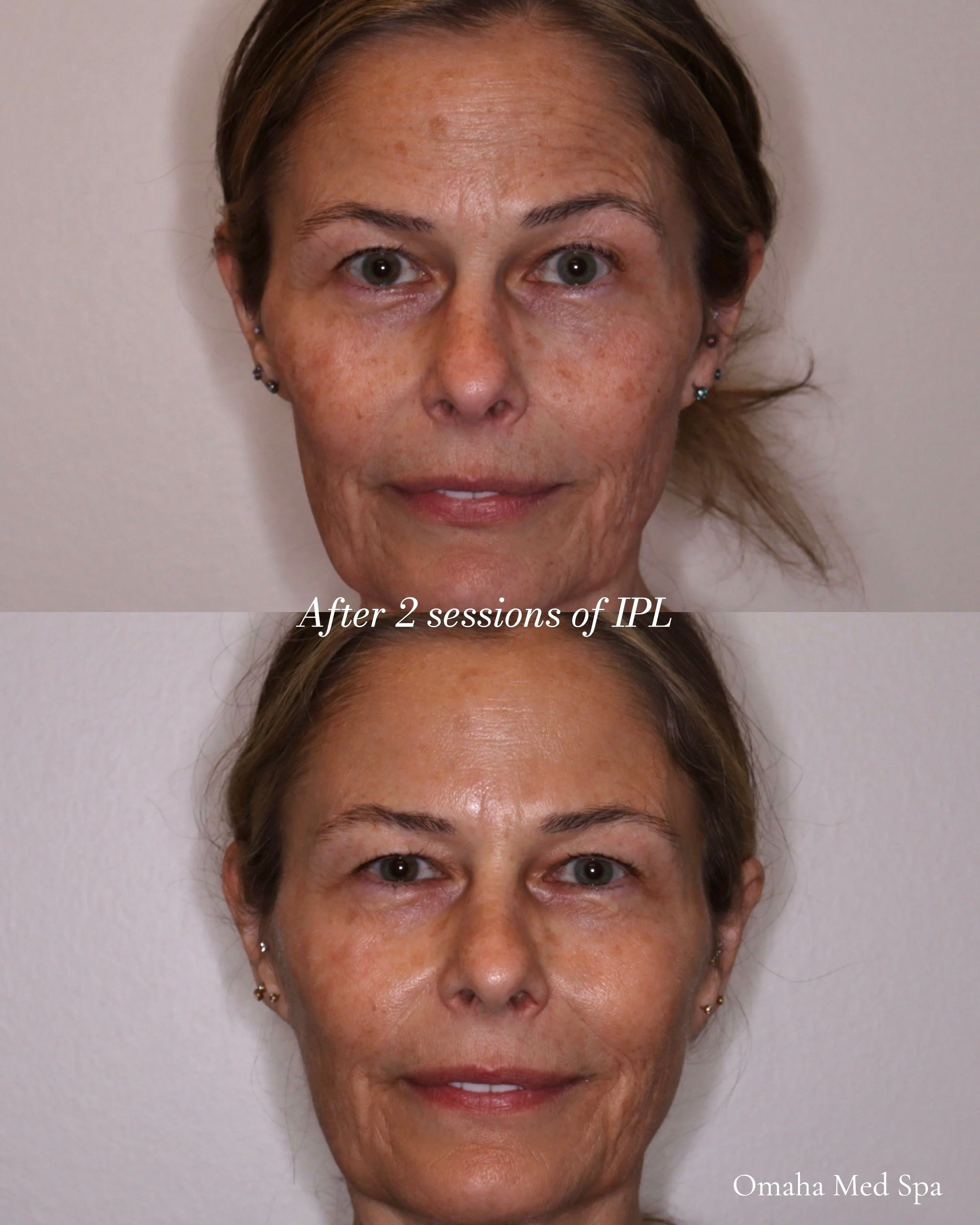 Before and After Skin Rejuvenation hand piece IPL (Intense Pulsed Light)