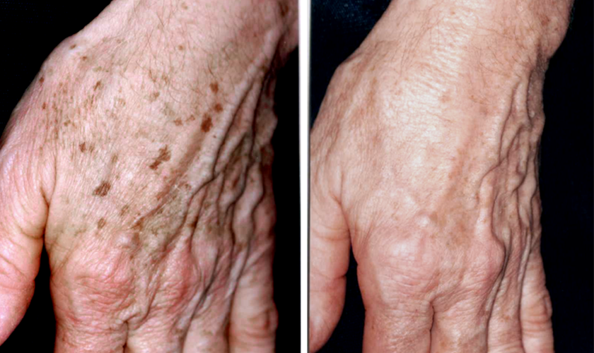 Close-up comparison of an elderly person's hand showing skin with age spots on the left and clear skin on the right.