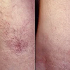 Comparison of skin with and without pubic hair, showing skin irritation or redness on the left side and smooth skin on the right side.