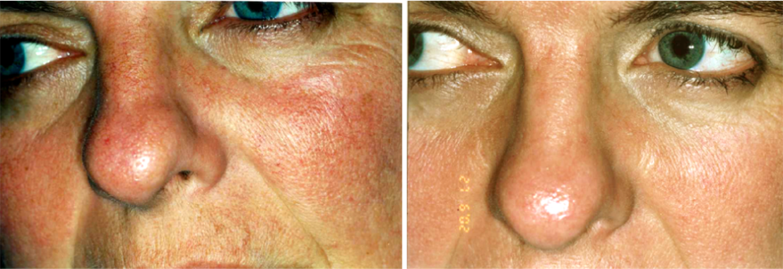 Close-up of a person's face showing a before-and-after comparison of skin condition, with reduced redness and improved skin texture on the right.
