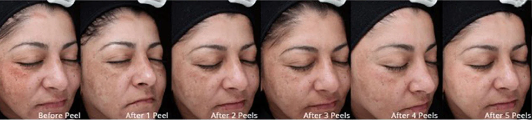A sequence of six photos showing a woman with dark hair and eyebrows, wearing a black headband, demonstrating the results of peeling skin. The photos are labeled from left to right as 'Before Peel' and 'After 1 Peel' through 'After 5 Peels,' showing progressive skin improvement, with the skin appearing smoother and clearer in later images.