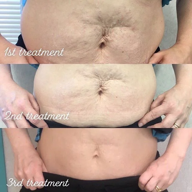 Progress photos showing the abdomen before and after three treatments, with visible reduction in skin looseness and stretch marks.