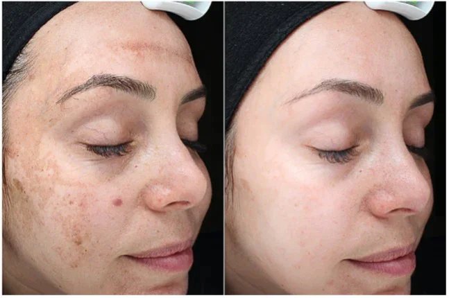 VI Precision Plus Peptide Peel