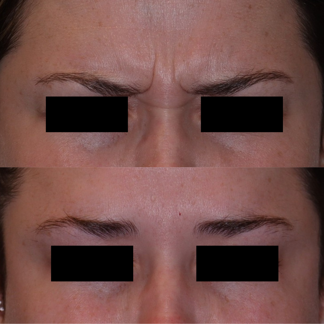 picture of forehead frown lines between the eyebrows before and after toxin Botox