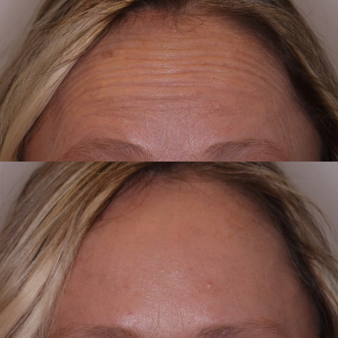 Before and After Toxin Forehead Lines