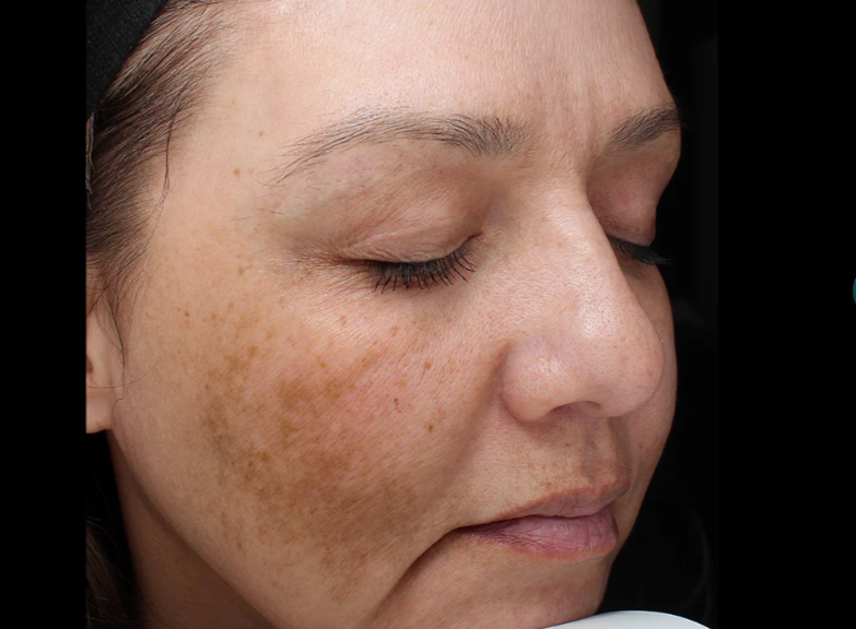 Close-up of a woman's face with visible sun damage and hyperpigmentation on her cheeks.