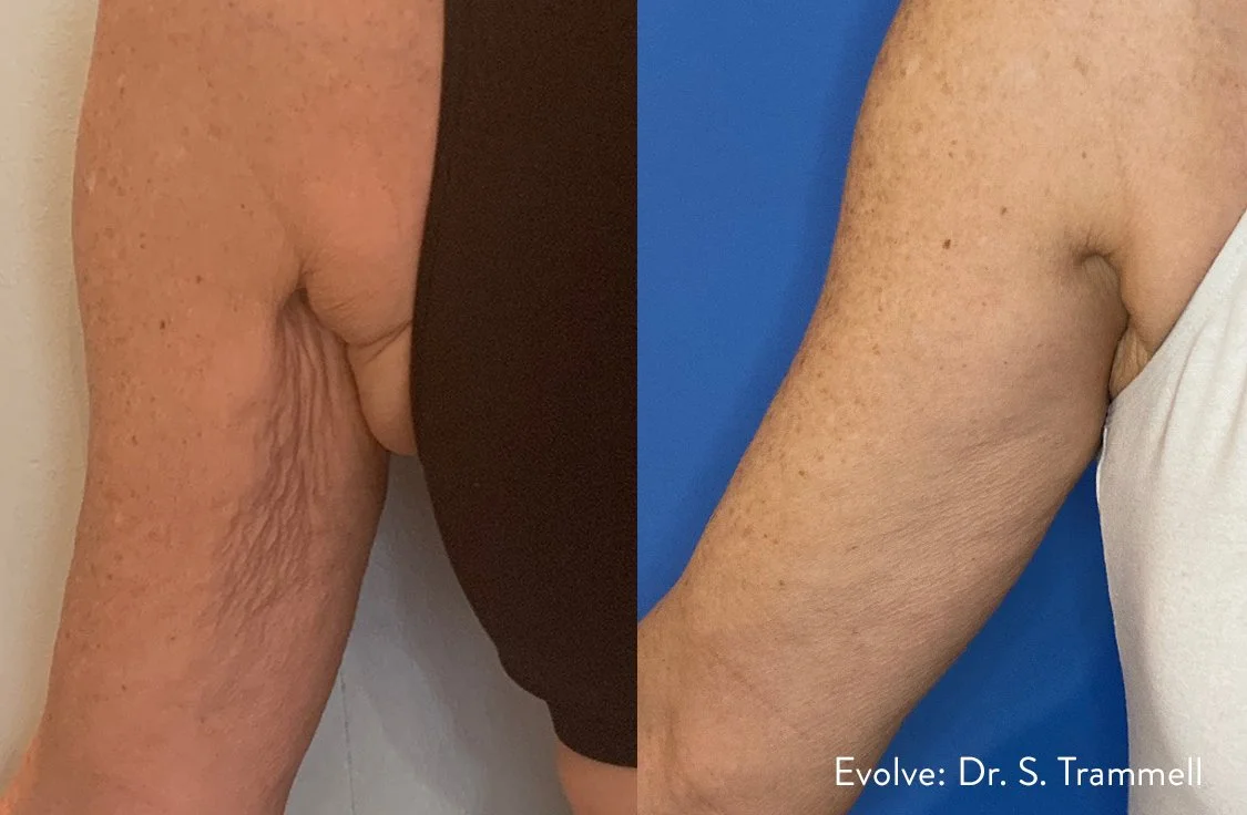 Side-by-side comparison of underarm skin, showing improved skin texture and firmness in the right image.