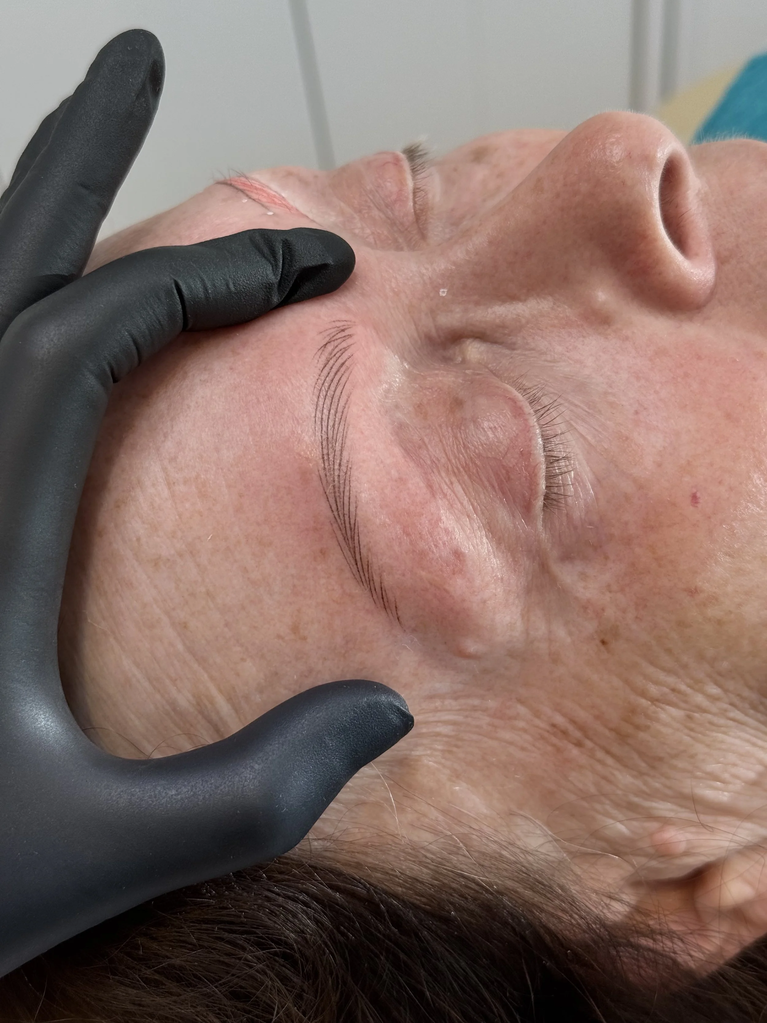 Nano Brows on person with alopecia