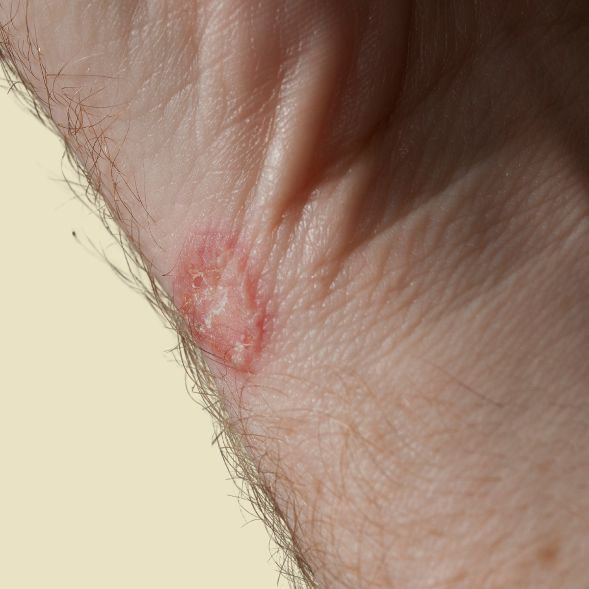 How Terbinafine Cream Works