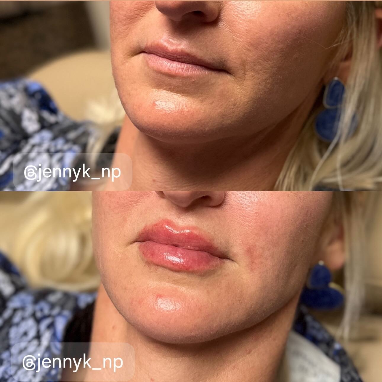 Lip Filler&hellip; Instantly Takes You From A 10 To A 💯

*Photos taken immediately after injections swelling present and will subside* 

#lips #lipfiller #perioralsupport #hotgirl #np #nursepractitioner #vain #vainobx #obxnc