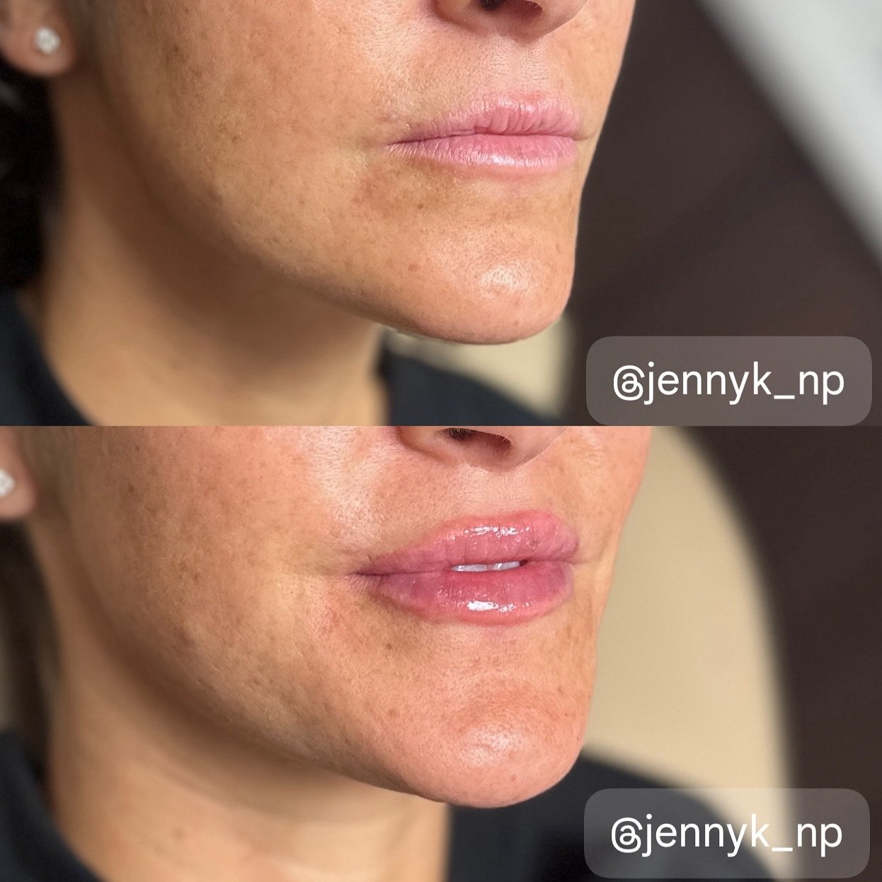 🔎 Focal Point 🔎

Did you know the eyes and lips are the primary focal points of the face? 

As we age we lose volume, hydration and our lips thin. 

Filler helps to restore what was lost. 

Book today to enhance your focal points. 

#focalpoint #ey