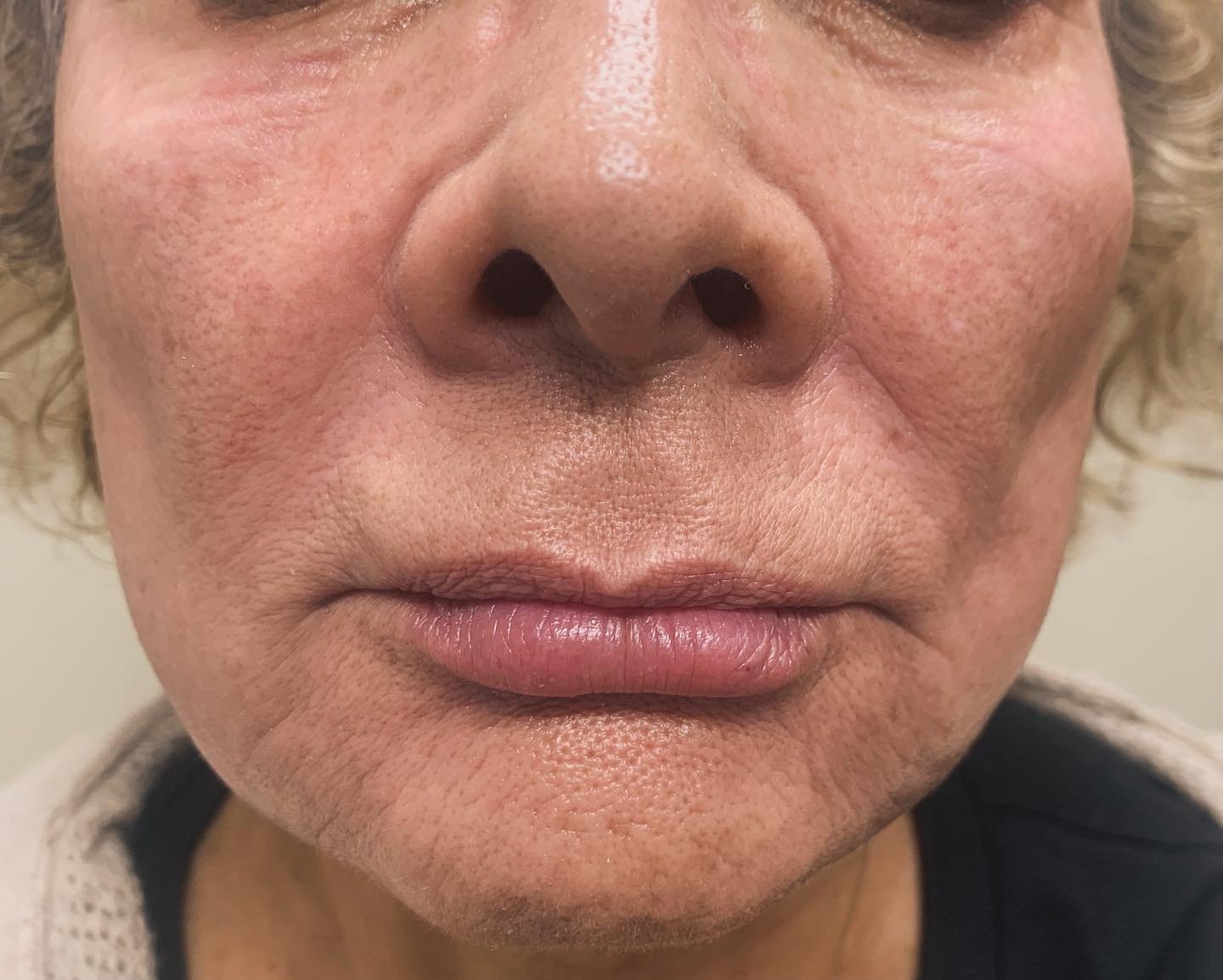 Cheeks lips, and folds. Subtle yet significant improvement in this beauty. #voluma #juvedermlips #botox #filler #ritablackmd