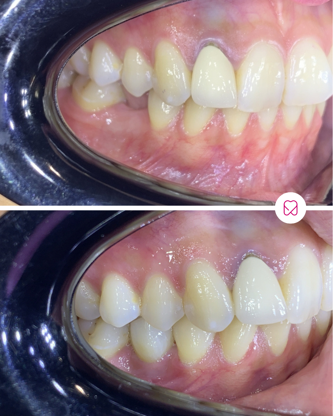 Close-up of lower teeth showing dental plaque before and after cleaning. The top image depicts teeth with visible plaque buildup, while the bottom image shows cleaner teeth after cleaning.