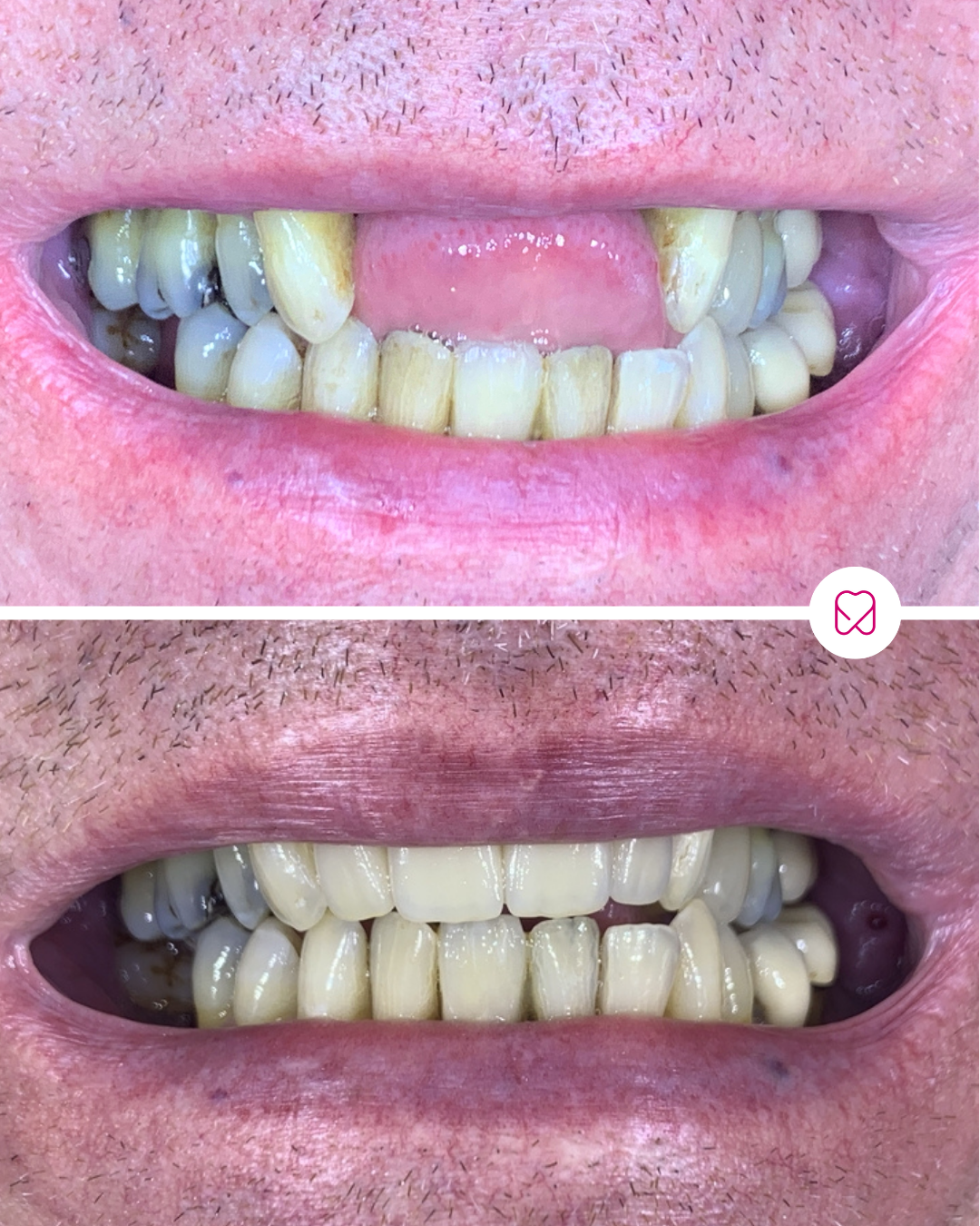 Comparison of a person's teeth before and after dental cleaning. The top image shows stained, yellow teeth with plaque and decay, while the bottom image shows cleaner, whiter teeth with improved appearance.