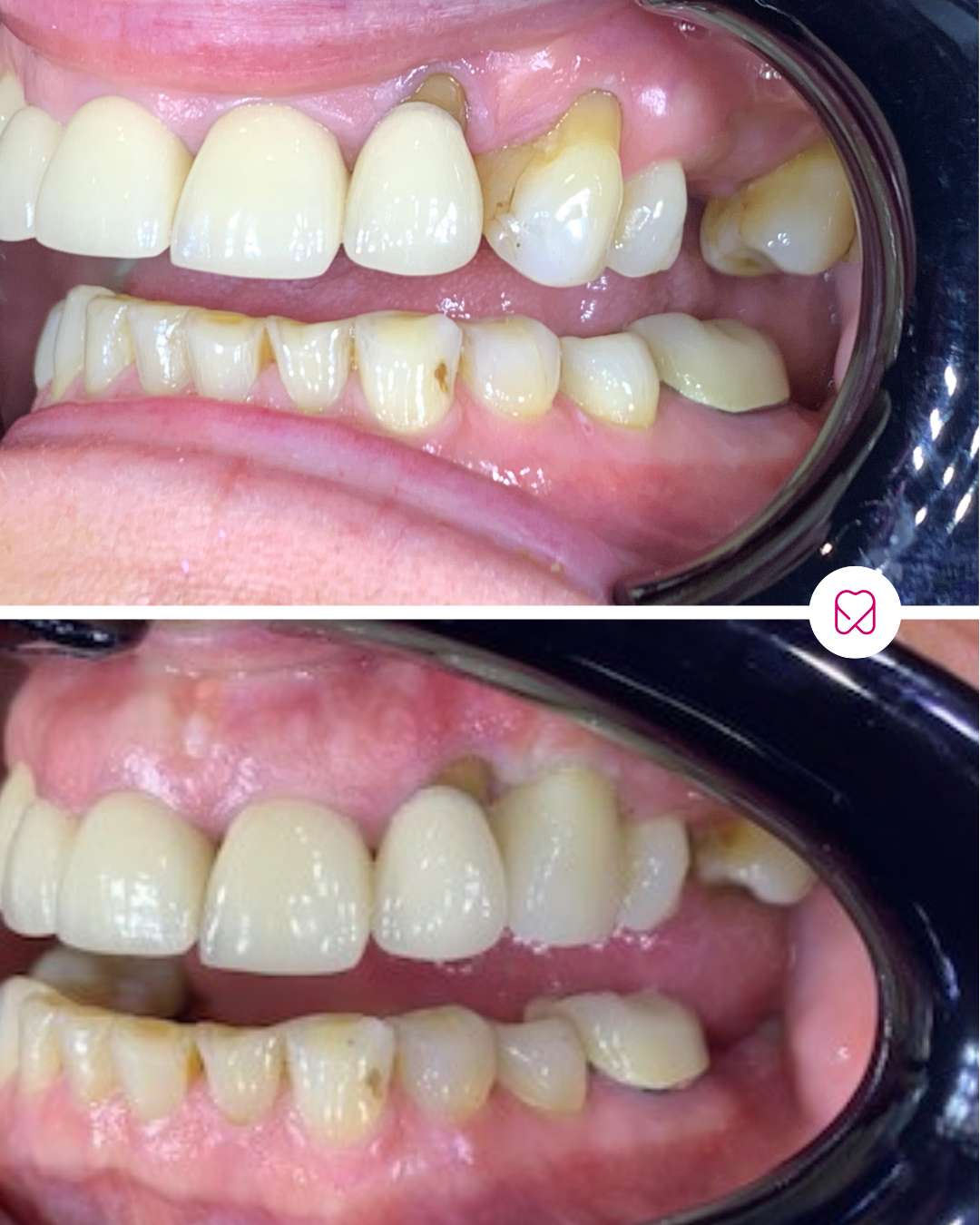 Close-up of person's teeth showing before and after dental treatment, with the upper teeth having dental crowns and the lower teeth showing signs of decay and wear.