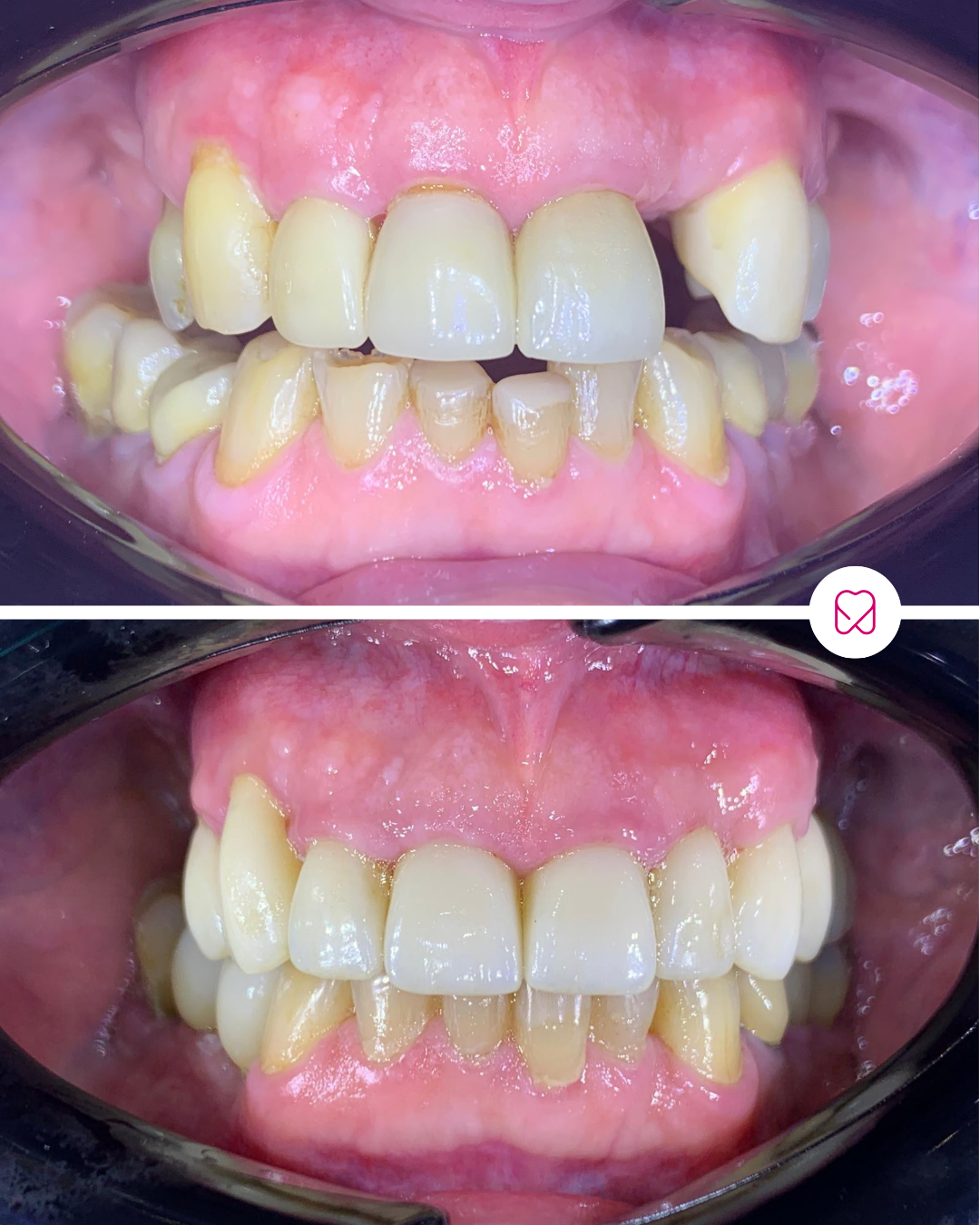 Comparison of teeth before and after dental cleaning or orthodontic treatment, showing improved alignment and cleanliness in the lower image.