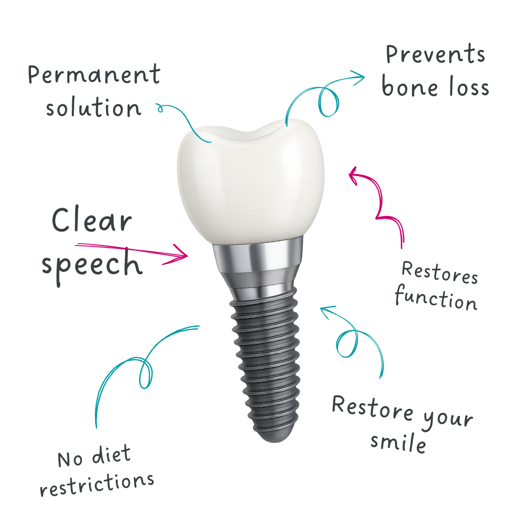 Diagram of a dental implant showing crown, abutment, and implant screw components.