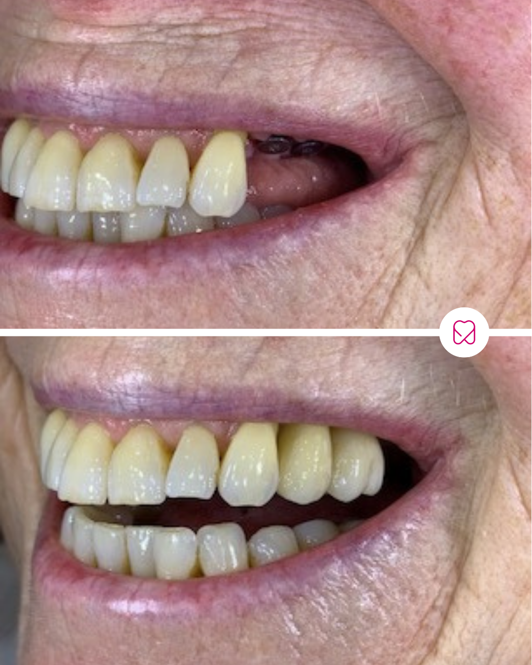 Close-up of a person's smile showing a dental transformation, with the upper teeth before and after dental veneers or crowns applied, revealing a whiter and more uniform smile in the after image.