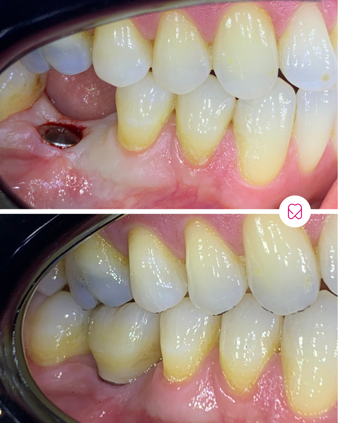 Comparison of lower teeth and gums showing before and after dental treatment. The top image depicts a tooth with a dental implant or cavity, while the bottom image shows the same area after treatment with the missing or damaged tooth restored.