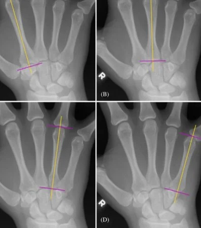 Exploring radiogrammetry beyond the second metacarpal: Using the third, fourth, and fifth metacarpals to quantify cortical bone