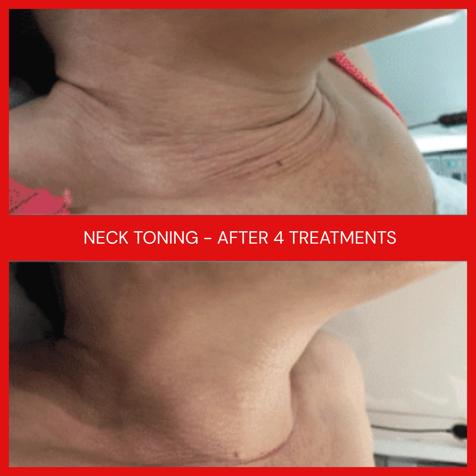 natural organic european micro current transdermalporation electroporation facial elapromed wrinkles, toning, eczema, psoriasis, inflammation, irritation, acne, scarring, stretch marks, cellulite, pigmentation, anti-aging winnipeg esthetics