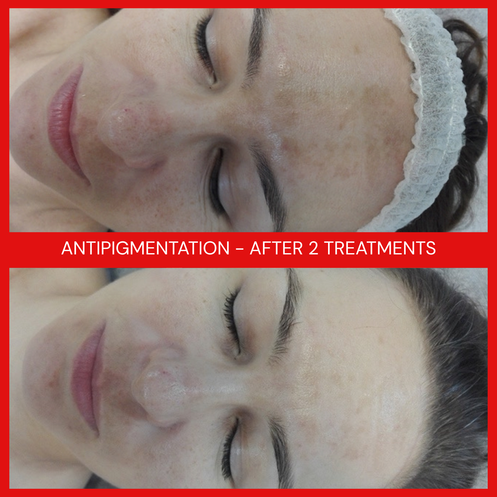 natural organic european micro current transdermalporation electroporation facial elapromed wrinkles, toning, eczema, psoriasis, inflammation, irritation, acne, scarring, stretch marks, cellulite, pigmentation, anti-aging winnipeg esthetics
