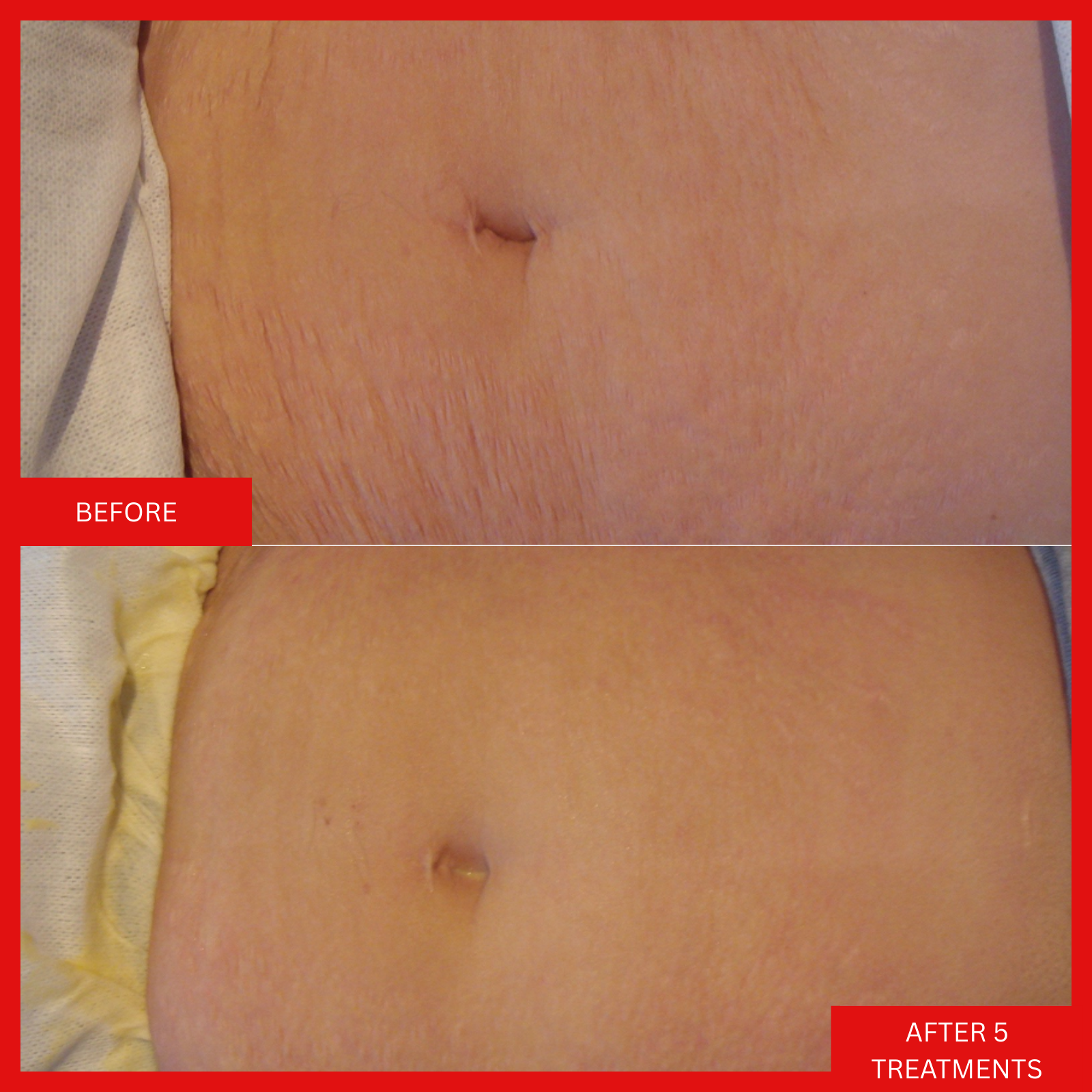 body-shaping-toning-skin-firming-saggy-stretch-mark-cellulite-treatment-winnipeg